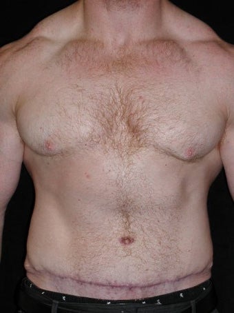 Male Tummy Tuck, Flank Liposuction, Male Breast Reduction