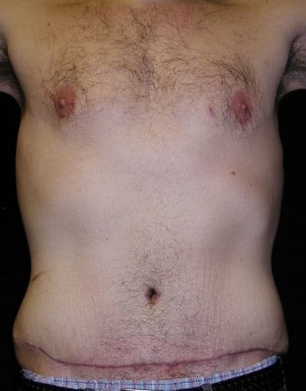 Male tummy Tuck, Flank Liposuction, Male Breast Reduction