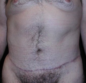 Male tummy Tuck