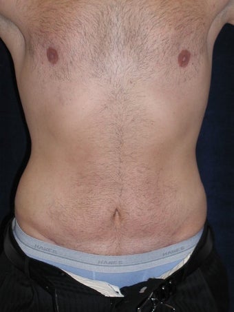 Male Tummy Tuck, Flank Liposuction, Male Breast Reduction