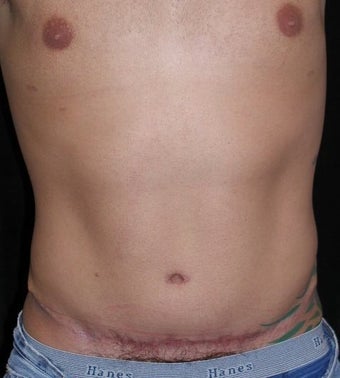 Male tummy Tuck, Flank Liposuction