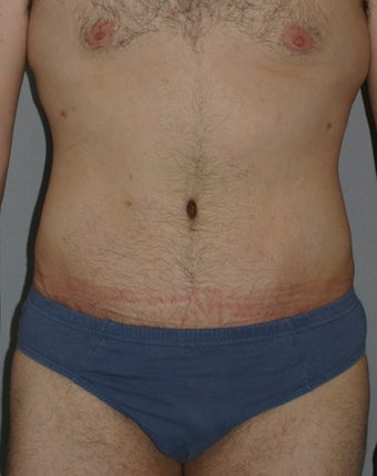 Male Abdominoplasty