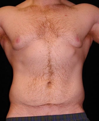 Male Tummy Tuck, Flank Liposuction, Male Breast Reduction