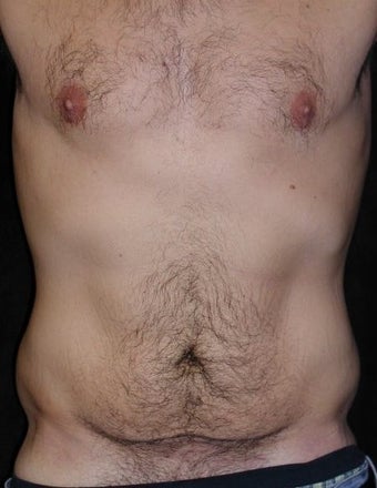 Male tummy Tuck, Flank Liposuction, Male Breast Reduction