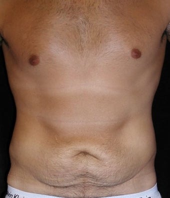 Male tummy Tuck, Flank Liposuction