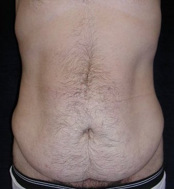 Male tummy Tuck