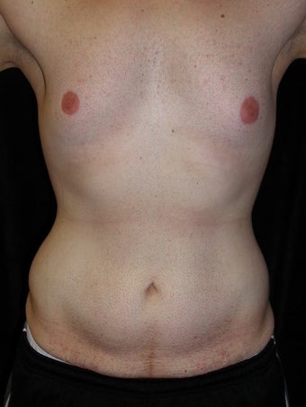 Male Tummy Tuck, Flank Liposuction, Male Breast Reduction