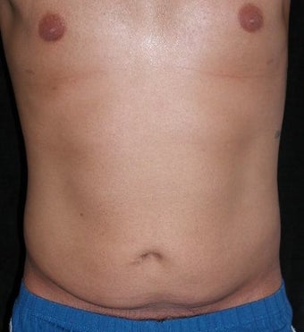 Male tummy Tuck, Flank Liposuction