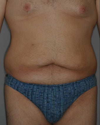 Male Abdominoplasty