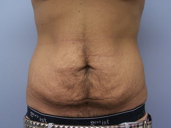 Tummy tuck for a male