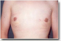 Male Breast Reduction/Gynecomastia