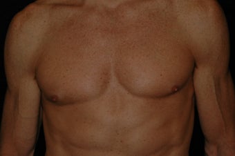 Gynecomastia surgery