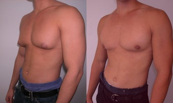 Gynecomastia 