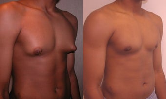 Gynecomastia
