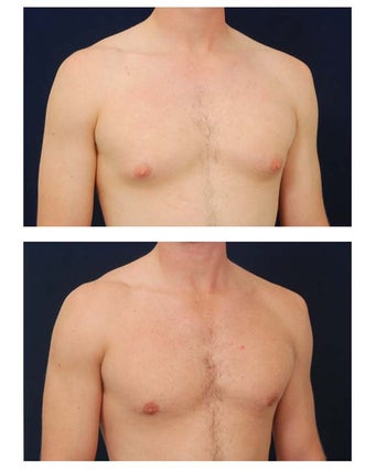 Gynecomastia