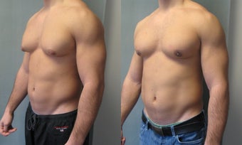 Gynecomastia New youk
