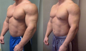Gynecomastia