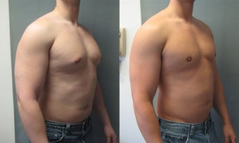 Gynecomastia 