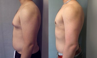 Gynecomastia 