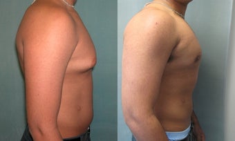 Gynecomastia 