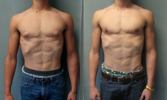 Gynecomastia