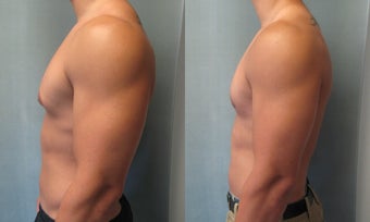 Gynecomastia 