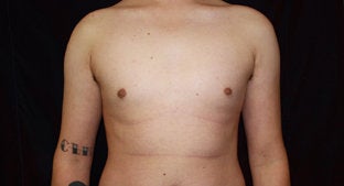 Gynecomastia 