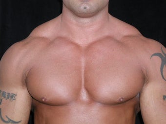 Male Breast Reduction