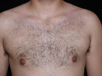 Male Breast Reduction
