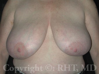 Transgender (F-M) mastectomies ("top surgery")