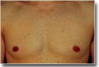 Male Breast Reduction/Gynecomastia