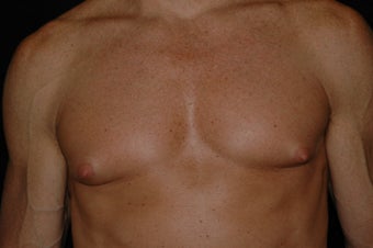 Gynecomastia surgery