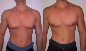 Gynecomastia 