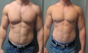 Gynecomastia