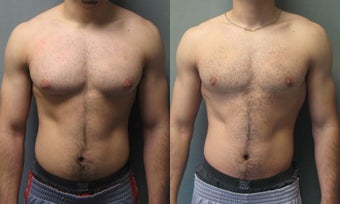 Gynecomastia