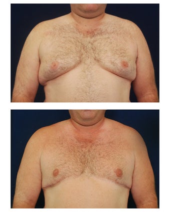 Gynecomastia