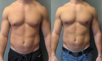 Gynecomastia New youk