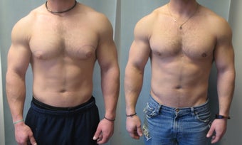 Gynecomastia surgery