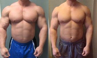 Gynecomastia