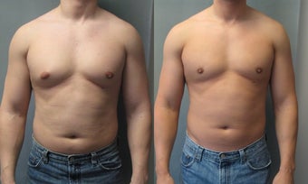 Gynecomastia 
