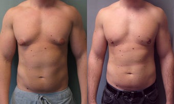 Gynecomastia 