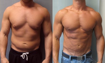Gynecomastia 