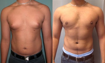 Gynecomastia 