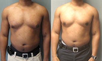 Male Breast Reduction 