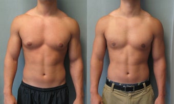 Gynecomastia 