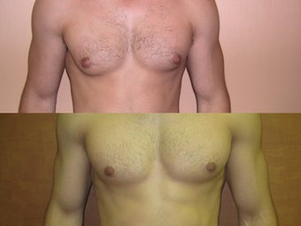 Liposuction for Male Breast Reduction/Gynecomastia