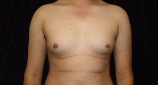 Gynecomastia 