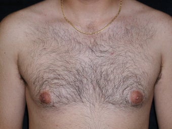 Male Breast Reduction