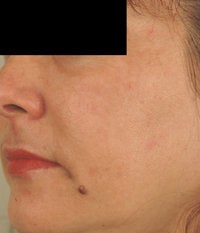 Melasma Treatment 
