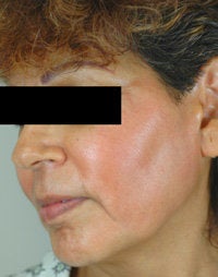 Melasma Treatment 